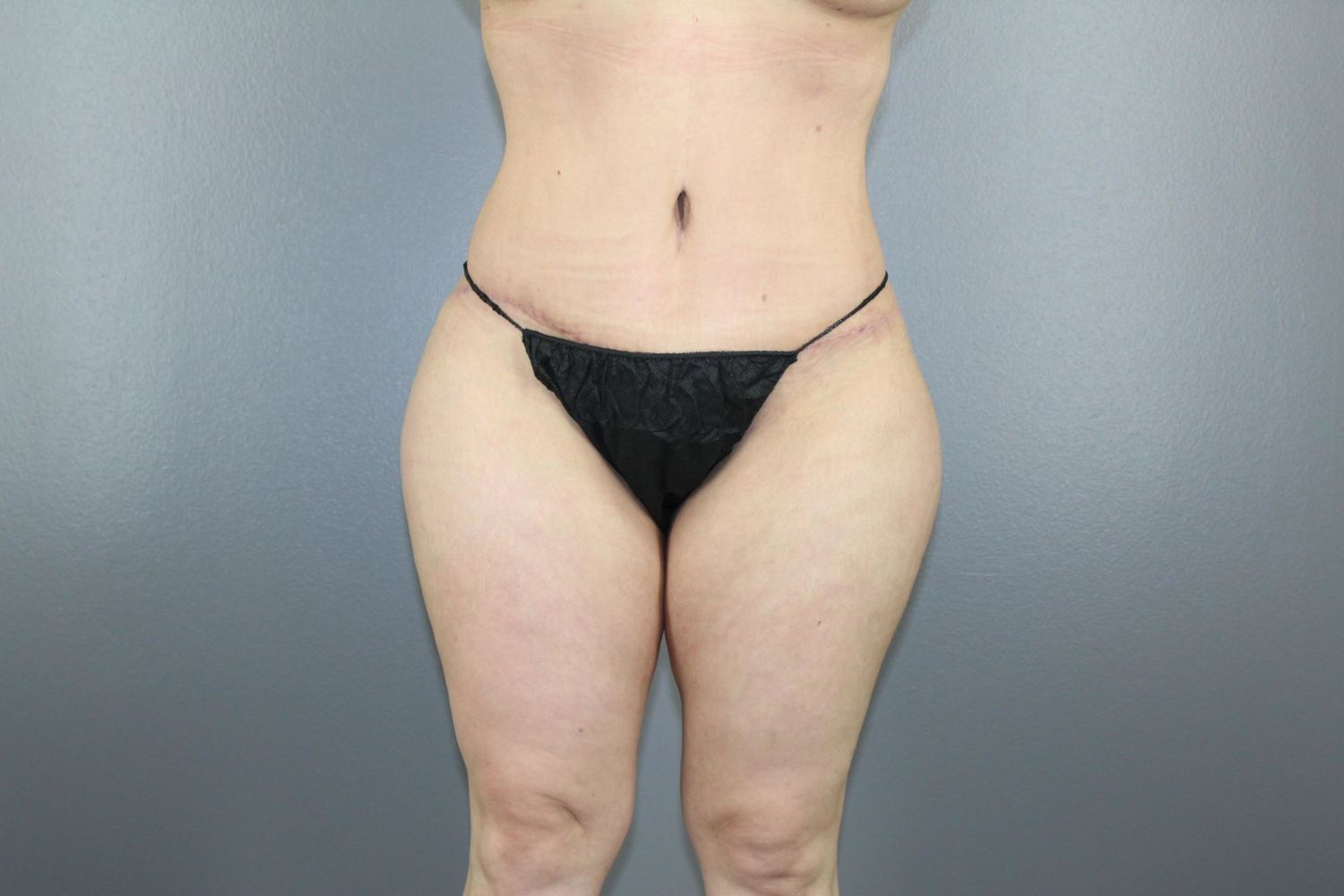 Body Contouring Before & After