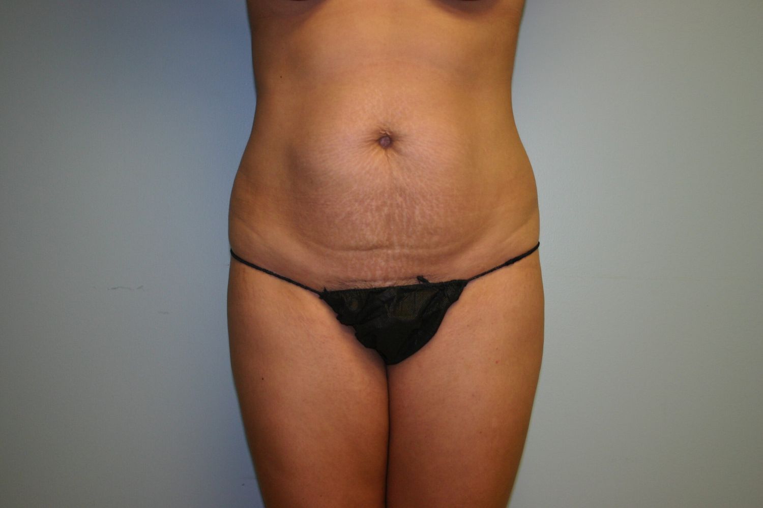 Body Contouring Before & After
