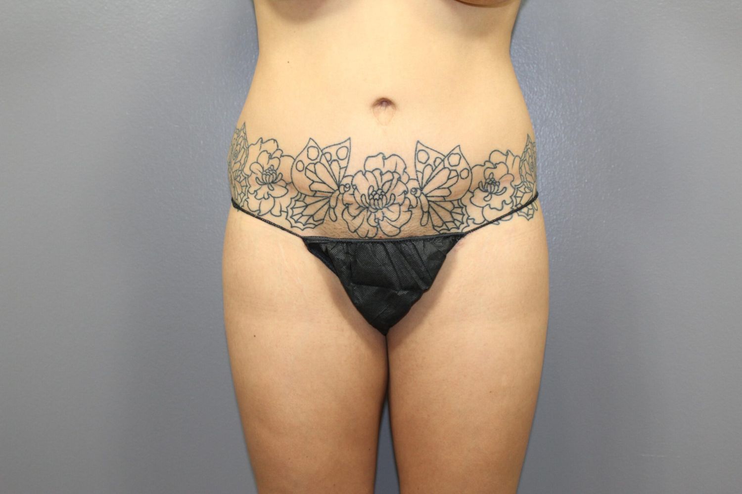 Body Contouring Before & After