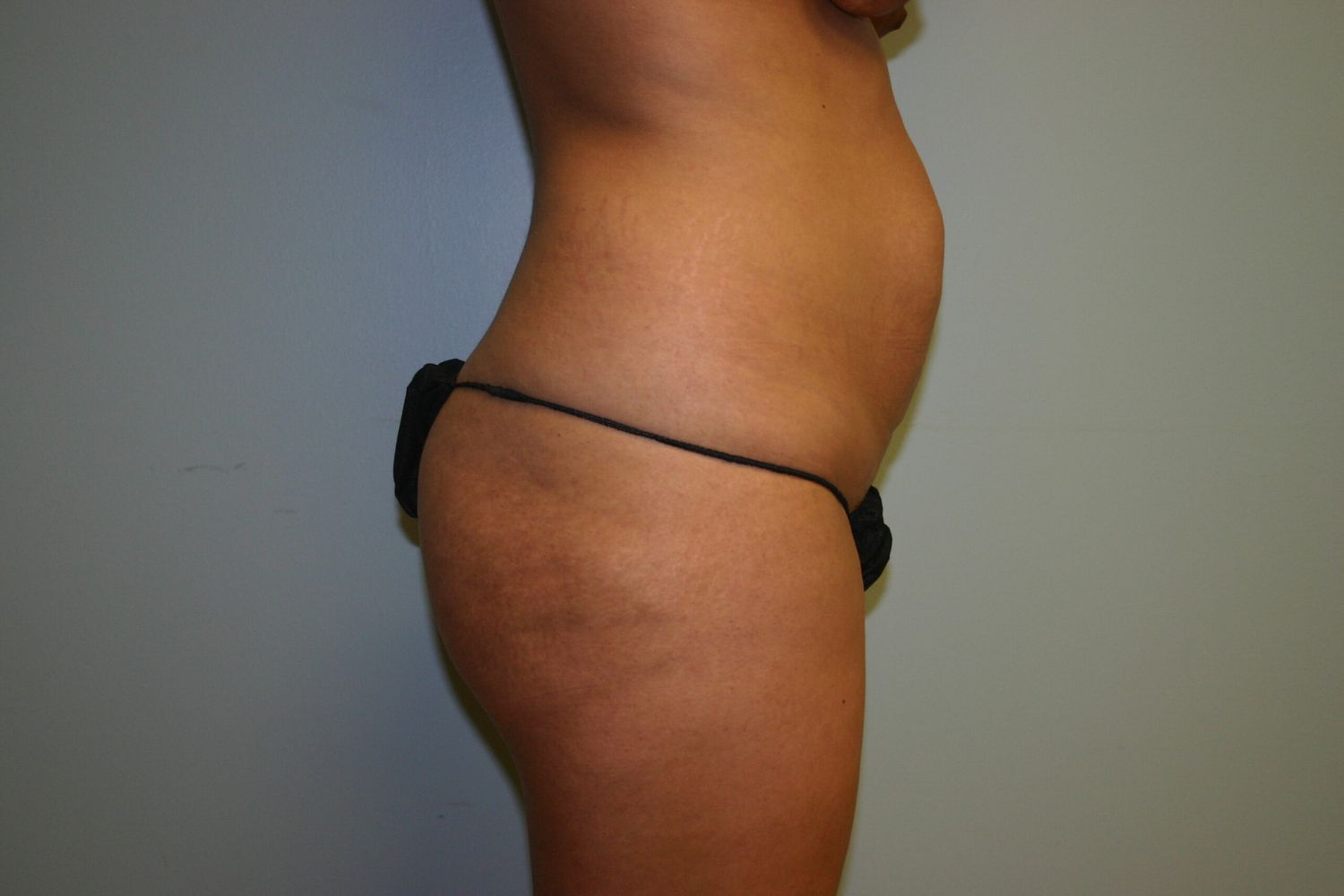 Body Contouring Before & After