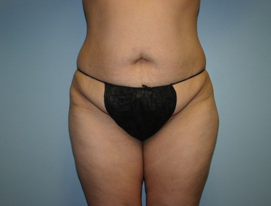 Body Contouring Before & After