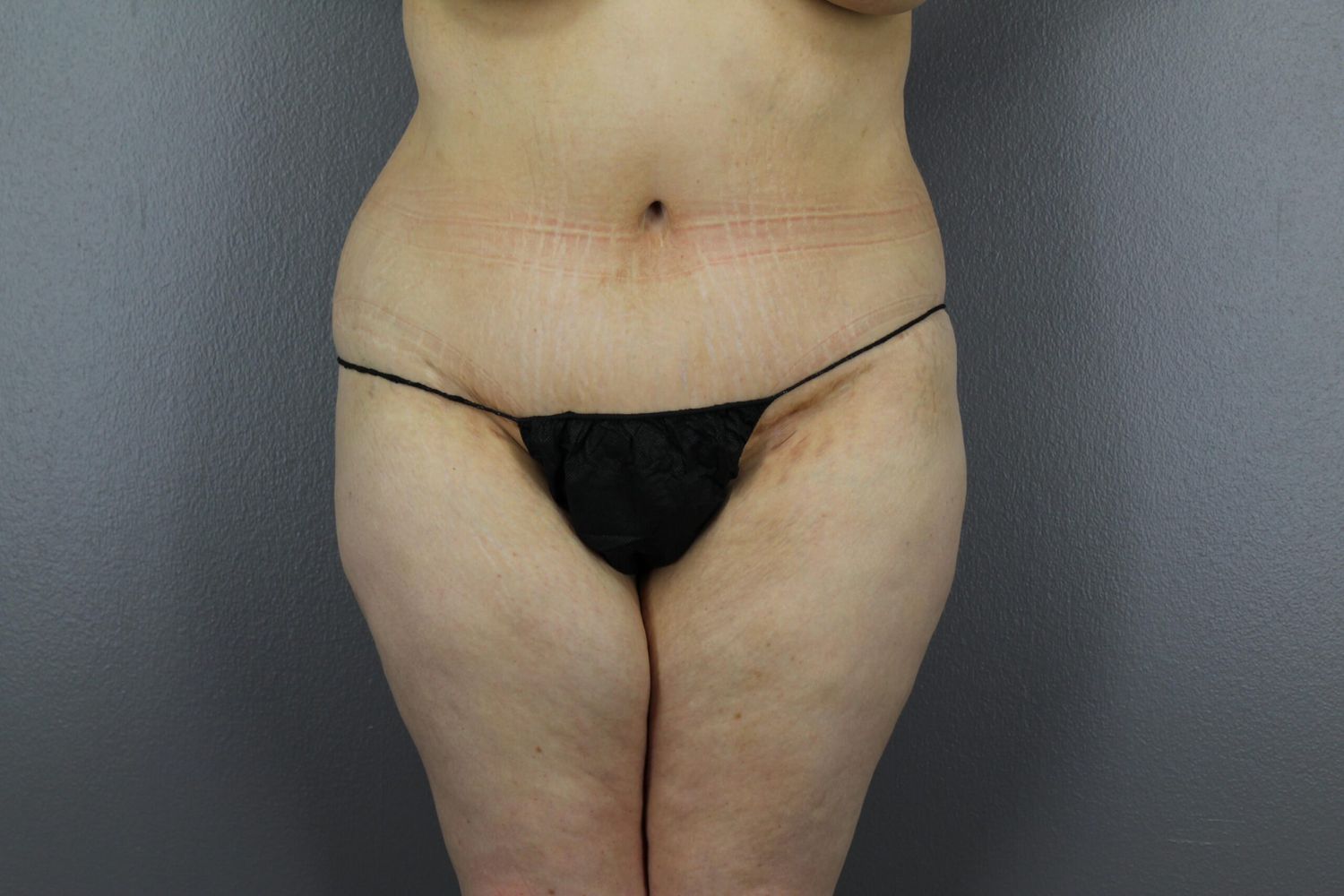 Body Contouring Before & After