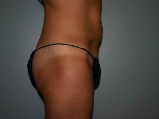 Body Contouring Before & After