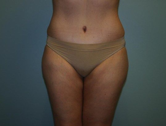 Body Contouring Before & After