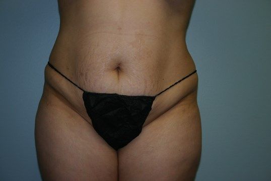 Body Contouring Before & After