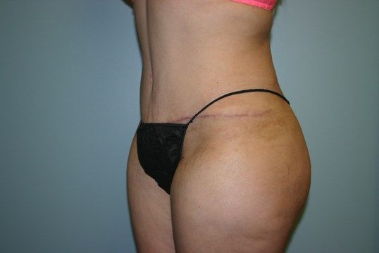 Body Contouring Before & After