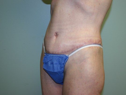 Body Contouring Before & After