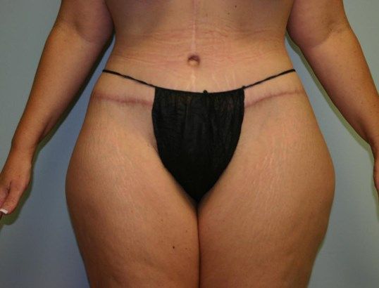 Body Contouring Before & After