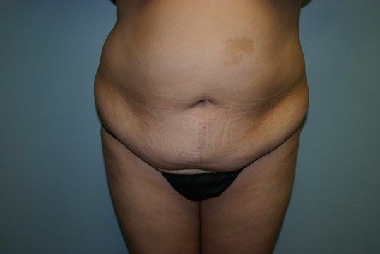 Body Contouring Before & After