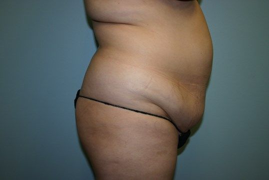 Body Contouring Before & After
