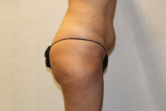 Body Contouring Before & After