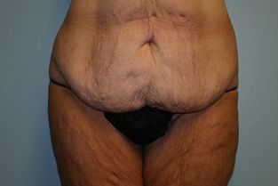 Body Contouring Before & After