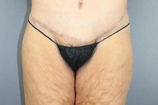 Body Contouring Before & After