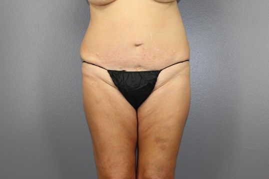 Body Contouring Before & After