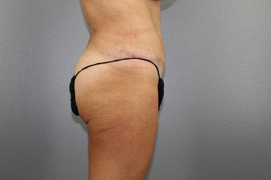 Body Contouring Before & After