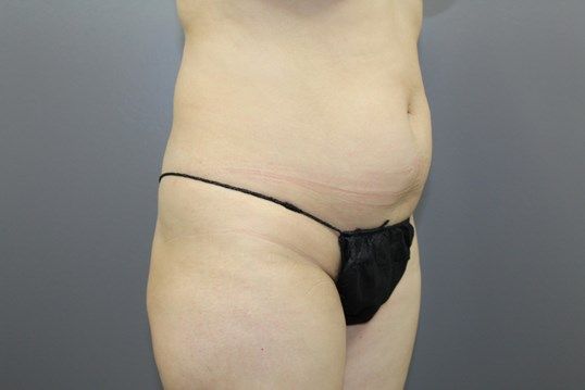 Body Contouring Before & After