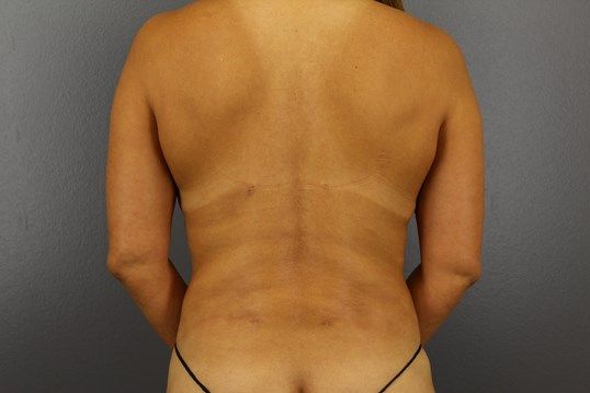 Body Contouring Before & After