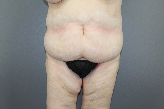 Body Contouring Before & After