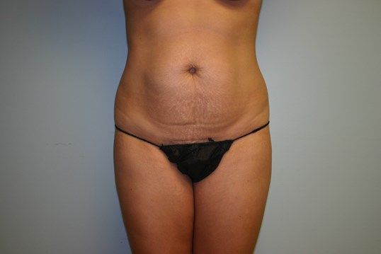 Body Contouring Before & After