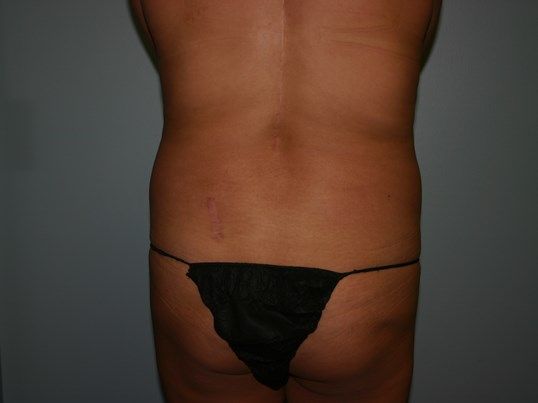 Body Contouring Before & After