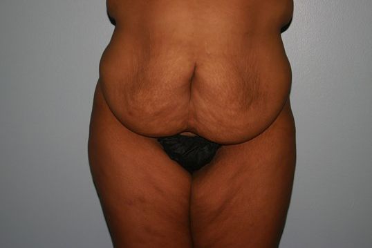 Body Contouring Before & After