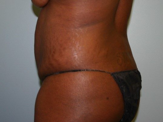 Body Contouring Before & After