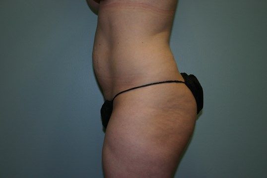 Body Contouring Before & After