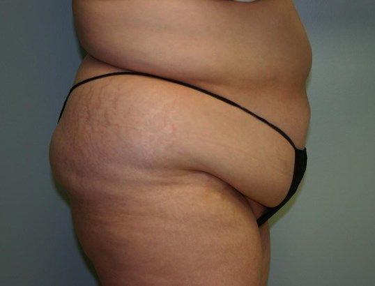 Body Contouring Before & After