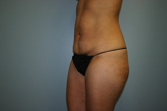 Body Contouring Before & After