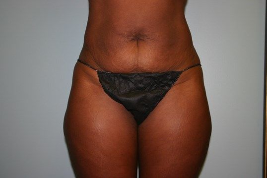 Body Contouring Before & After