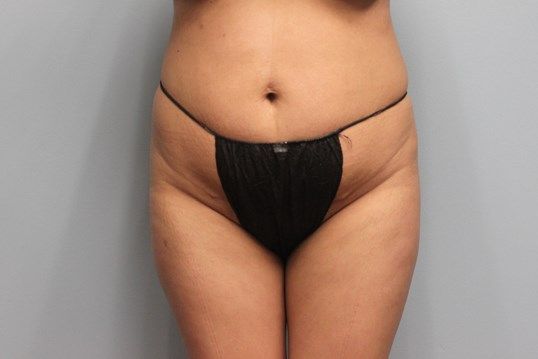 Body Contouring Before & After