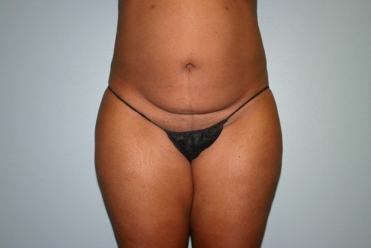 Body Contouring Before & After