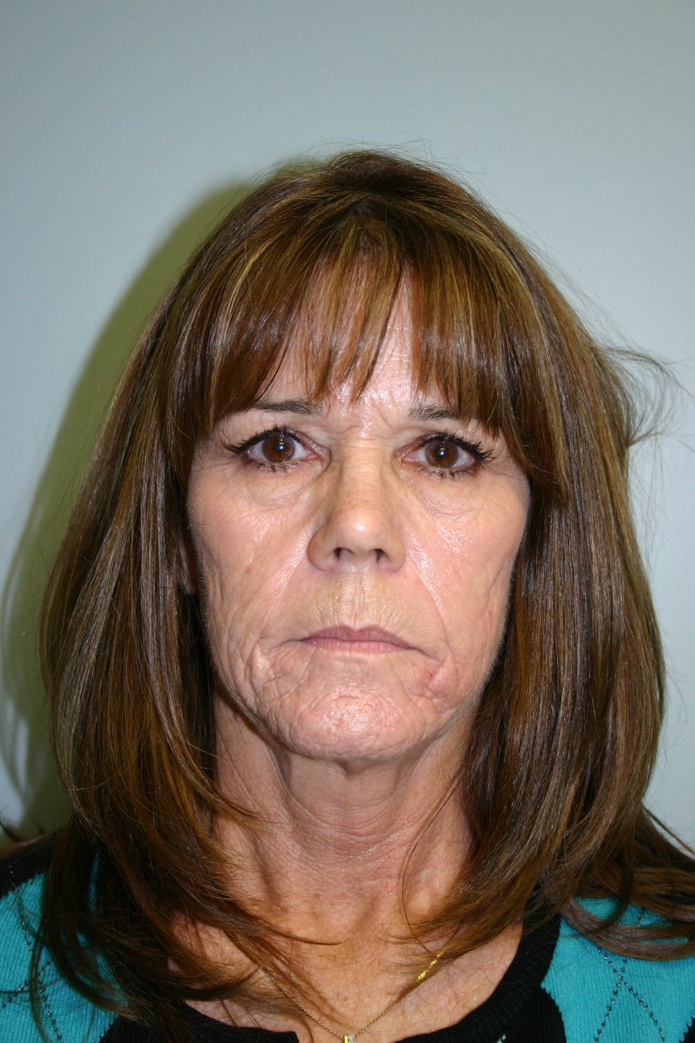 Laser Skin Resurfacing Before & After