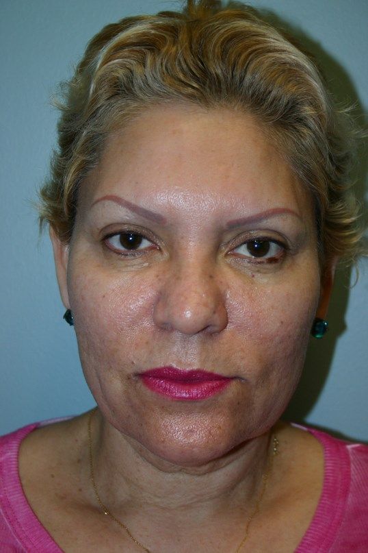 Laser Skin Resurfacing Before & After