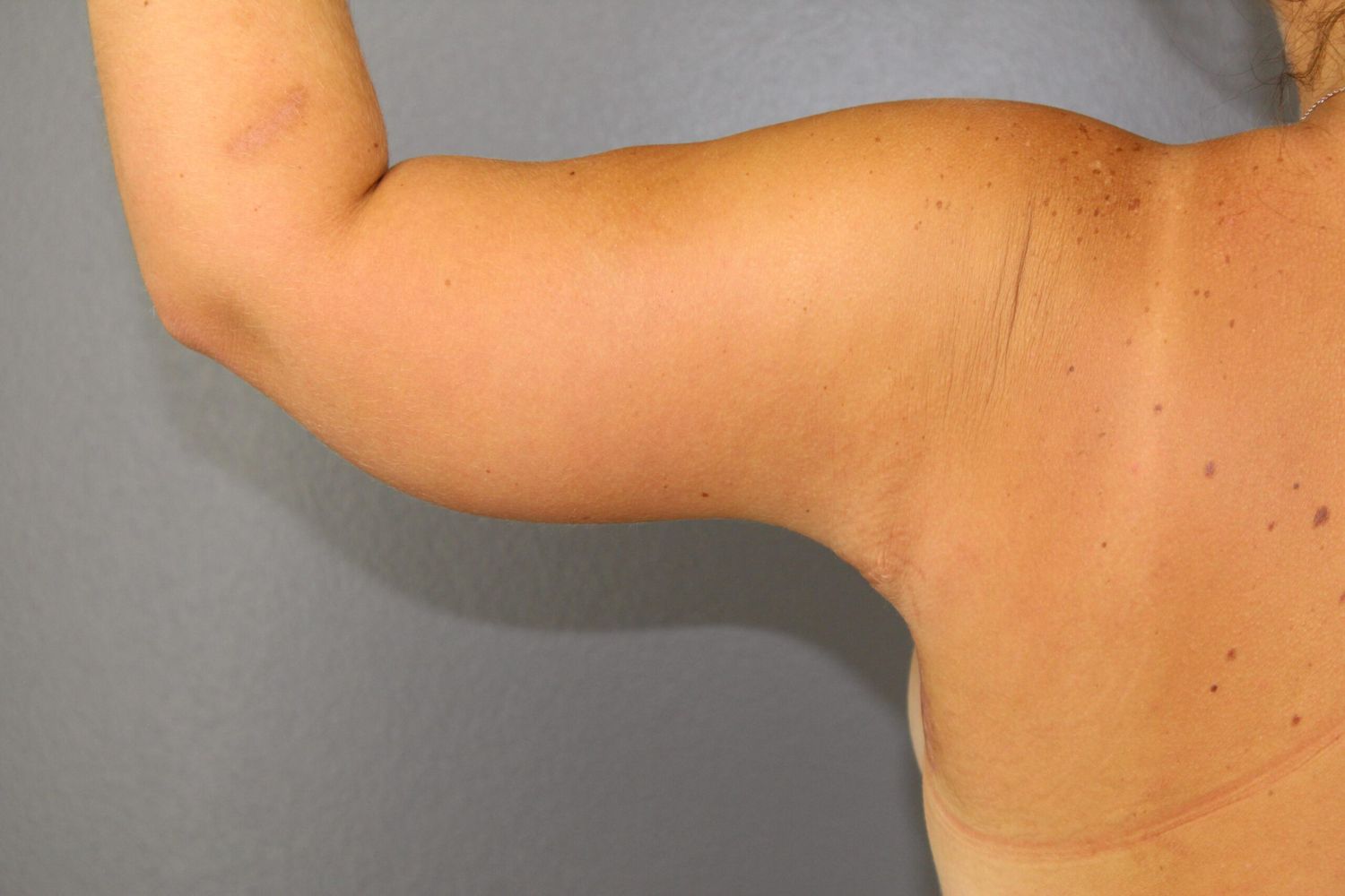 Arm Lift Before & After