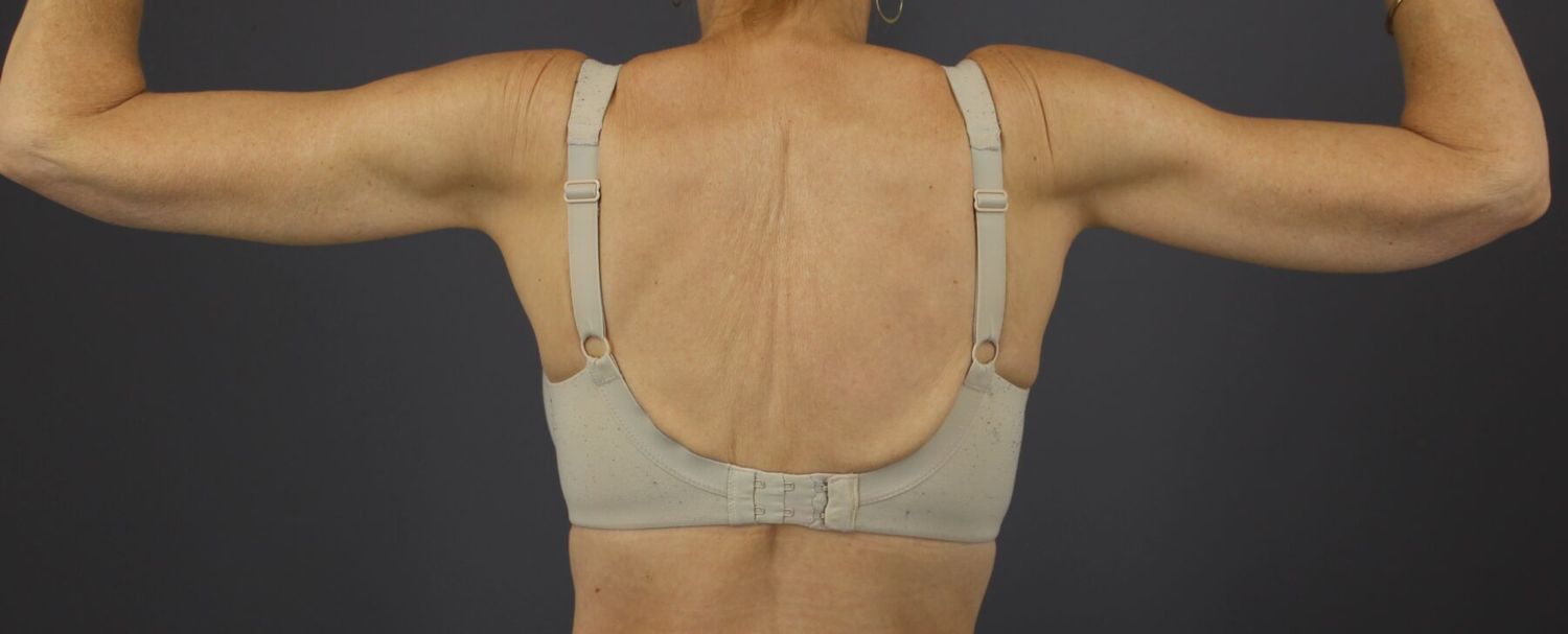 Arm Lift Before & After