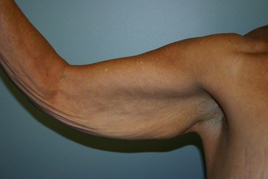 Arm Lift Before & After