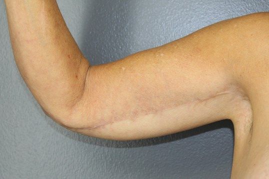 Arm Lift Before & After