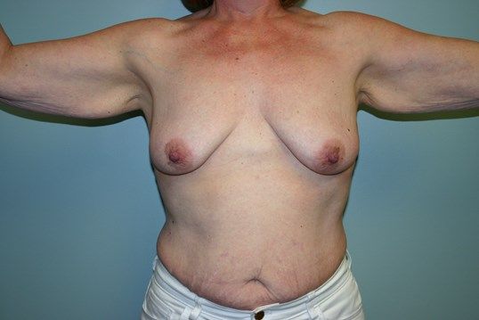 Arm Lift Before & After