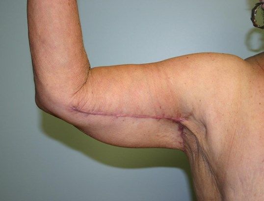 Arm Lift Before & After