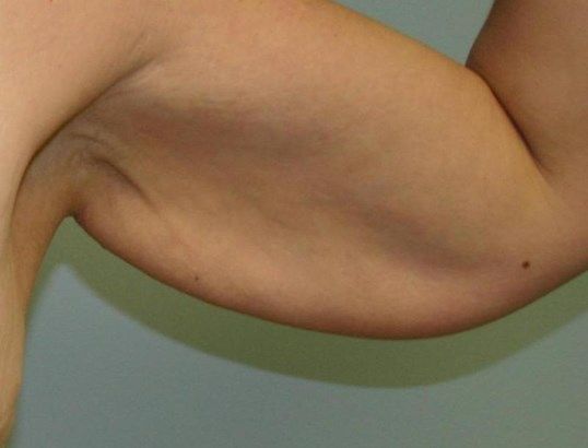 Arm Lift Before & After