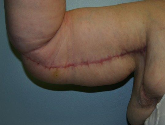 Arm Lift Before & After