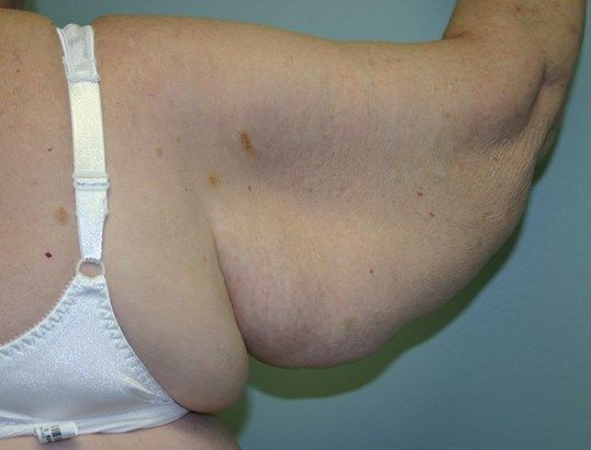 Arm Lift Before & After