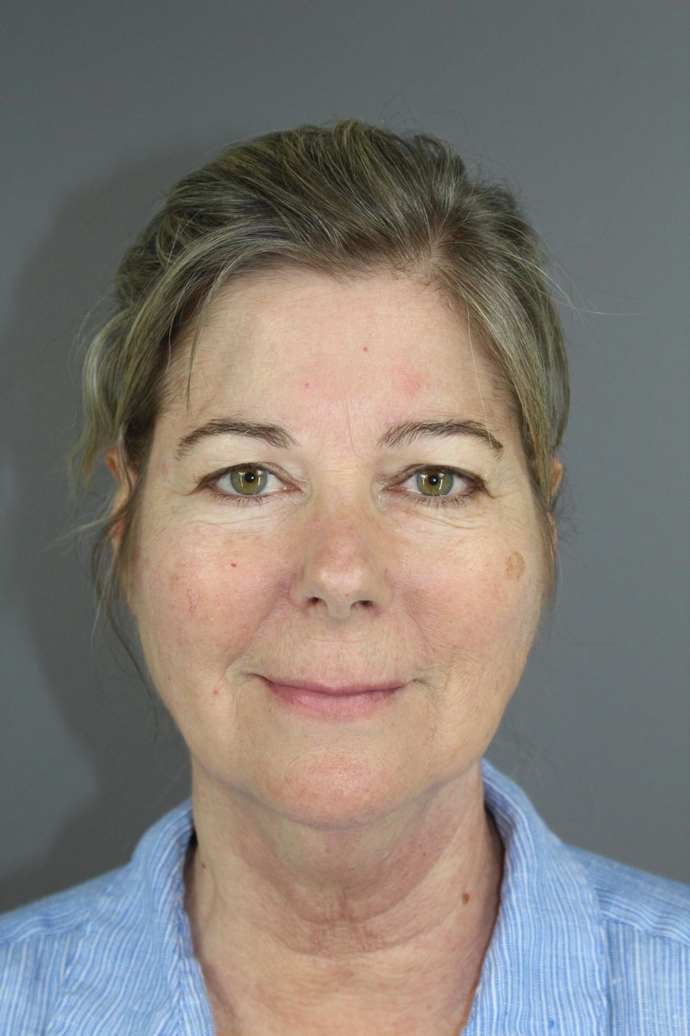 Face Lift Before & After