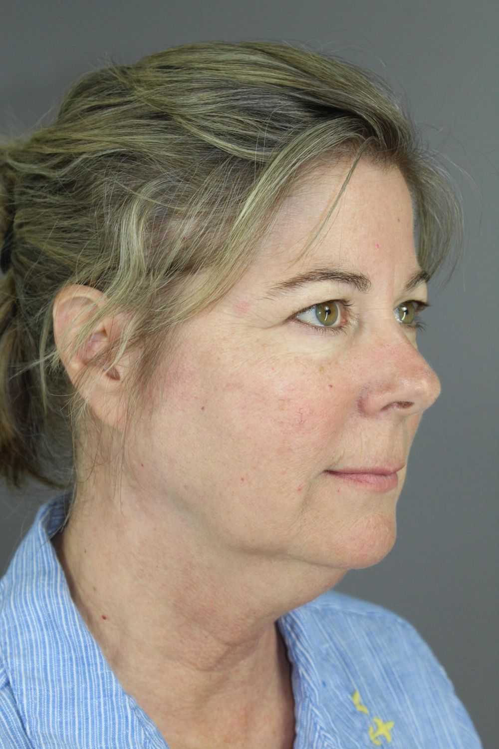 Face Lift Before & After