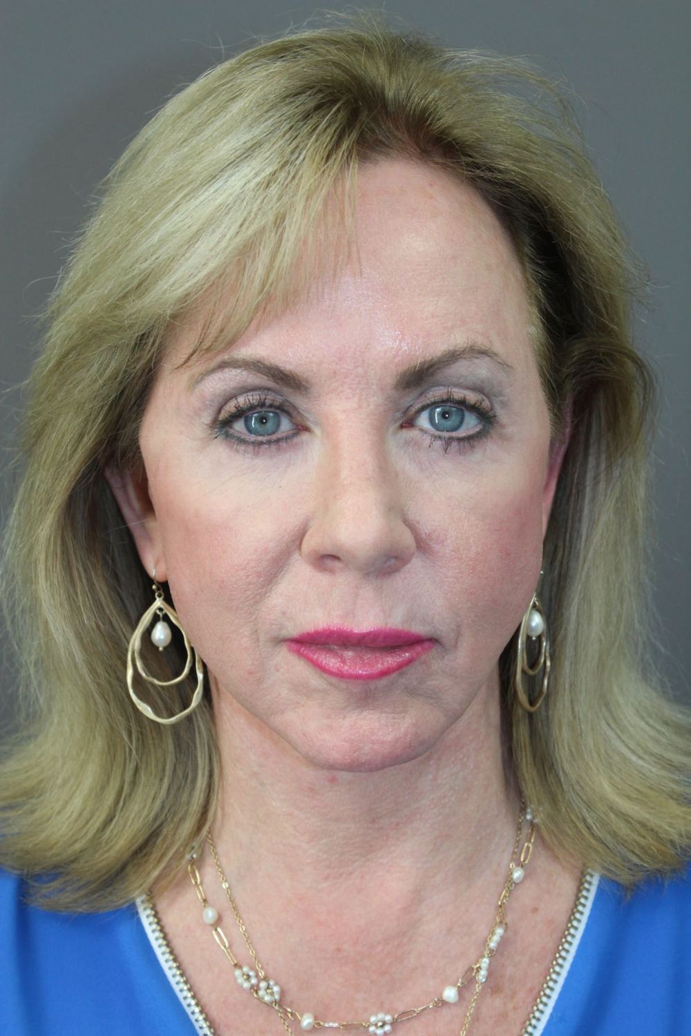 Face Lift Before & After