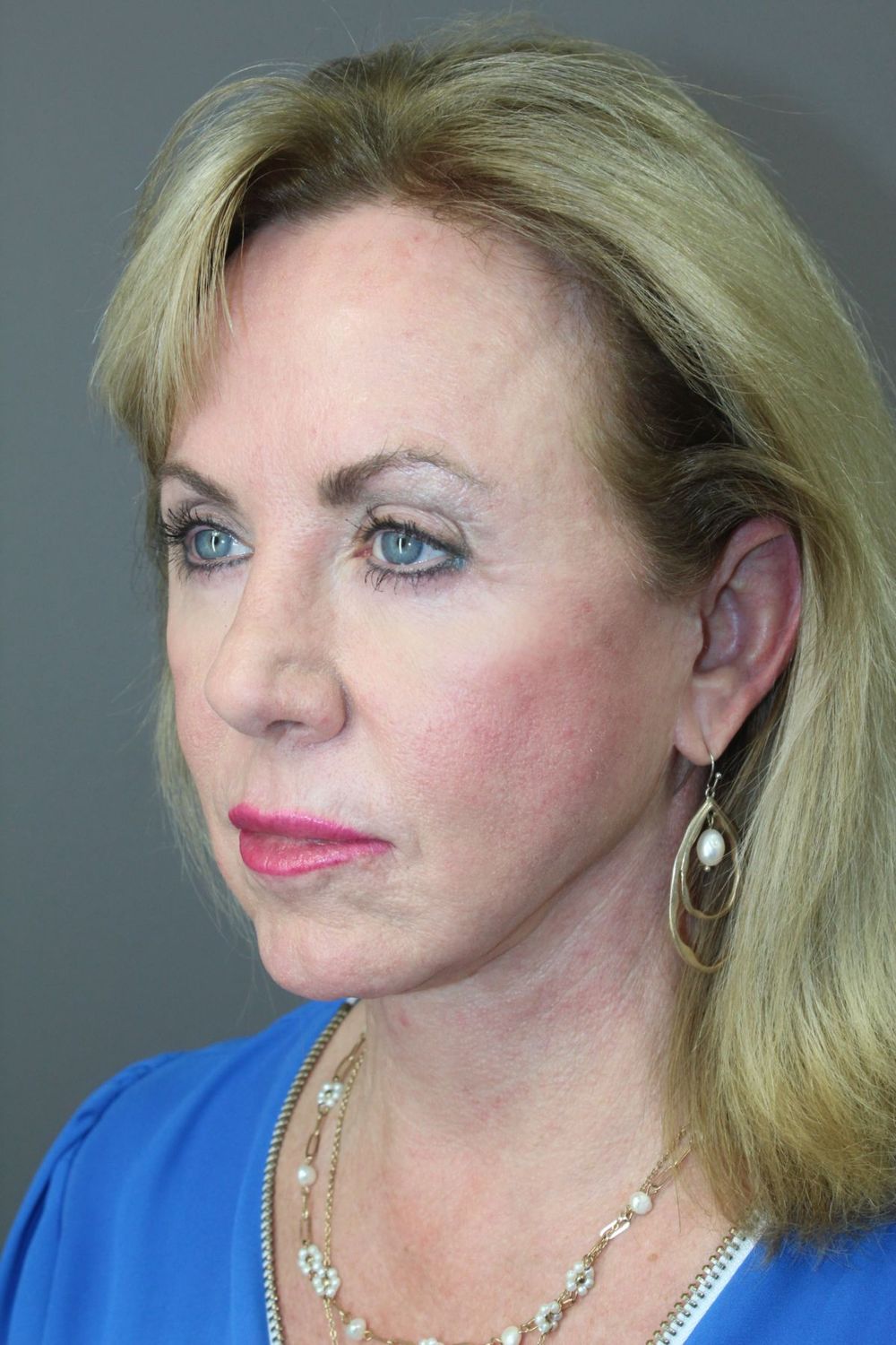 Face Lift Before & After