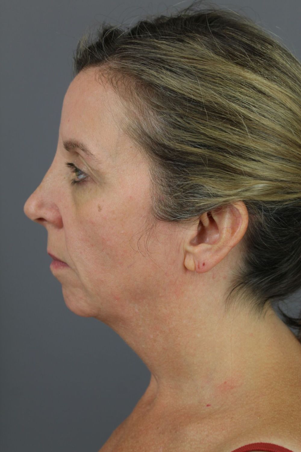 Face Lift Before & After