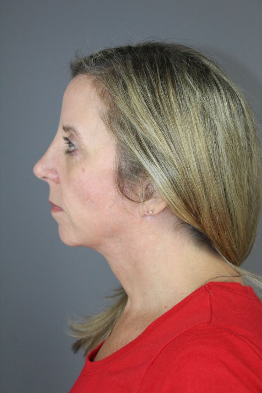 Face Lift Before & After