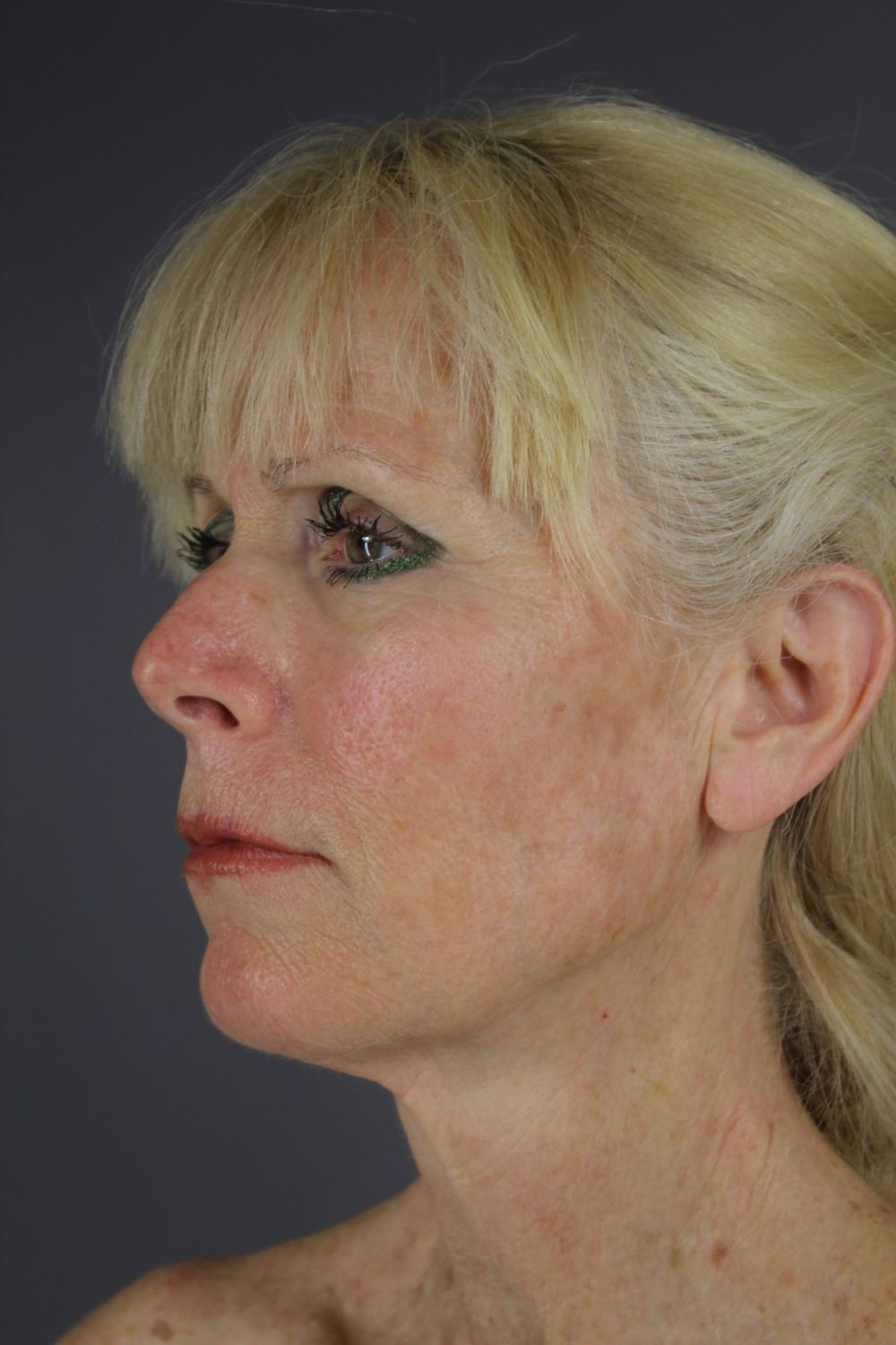 Face Lift Before & After